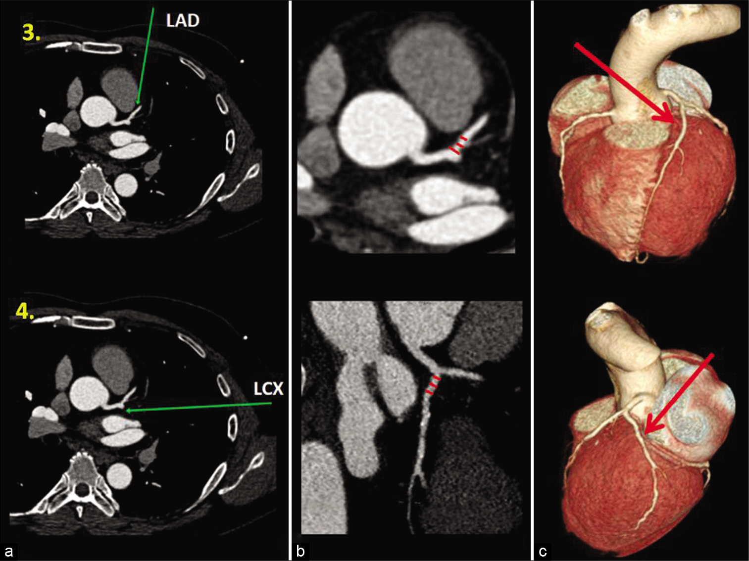 Coronary artery diameter measurements (continued with [Figure 1]). Axial CT-CAG (3a, 3b and 4a), curved planar reformatted (4b) and (3d), and volume rendered images (3c and 4c) shows normal anatomy (green and red arrows) of the left anterior descending artery-LAD (panel 3) and left circumflex artery-LCX (panel 4). The coronary artery diameter measurements were taken in a similar way (i.e., within the proximal 10 mm segment after bifurcation from the LMCA) with equidistant points (red color lines) in the LAD as shown in (3b)-zoomed axial image, and the LCX as shown in curved planar reformatted image-4B. The three arbitrary measurements taken for each artery are then averaged for the final diameter of that particular coronary artery.