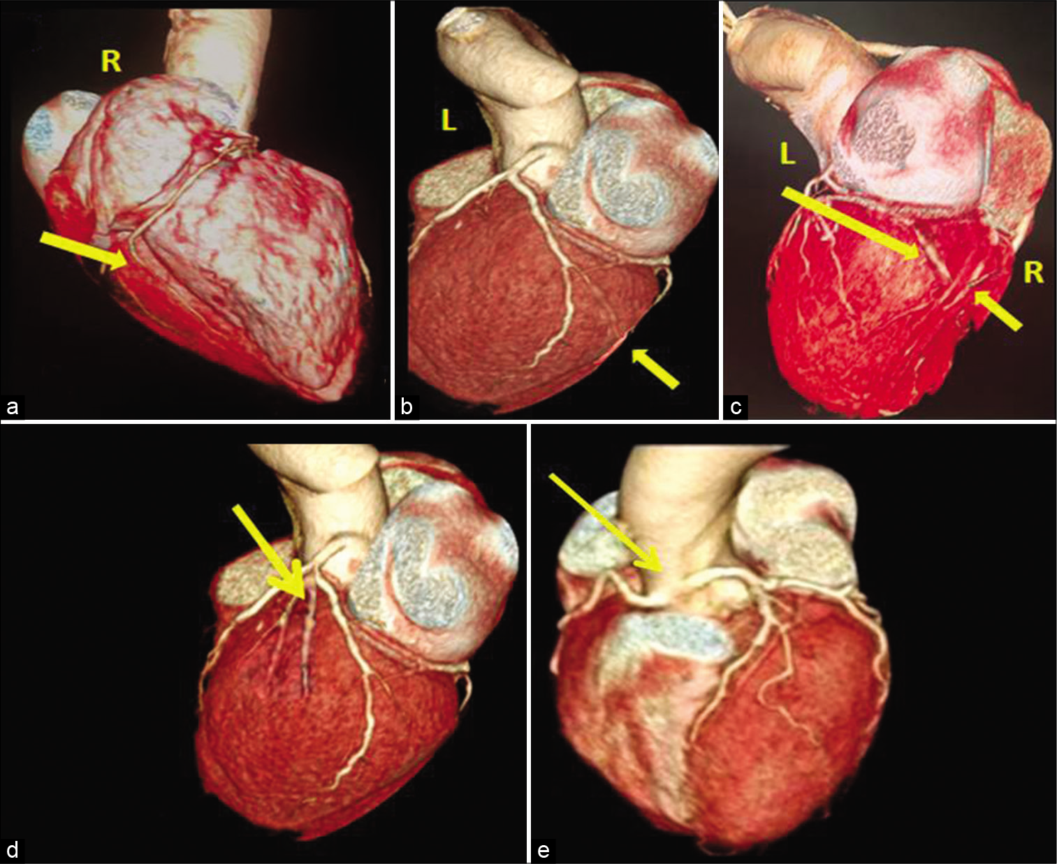 Coronary artery dominance and variants. The artery that contributes to posterior and inferior supply is the dominant artery. 3D volume rendered images show RCA (a), LCX (b) giving off the posterior descending artery – PDA branch (yellow arrows), hence right and left dominant arteries. (c) Shows that PDA branch is contributed by both RCA and LCX (yellow arrows); hence, it is codominant circulation. 3D volume rendered images (d) shows trifurcation of LMCA into LAD, LCX, and ramus intermedius (yellow arrow), and image (e) shows anomalous common origin of LMCA from right coronary sinus (yellow arrow).