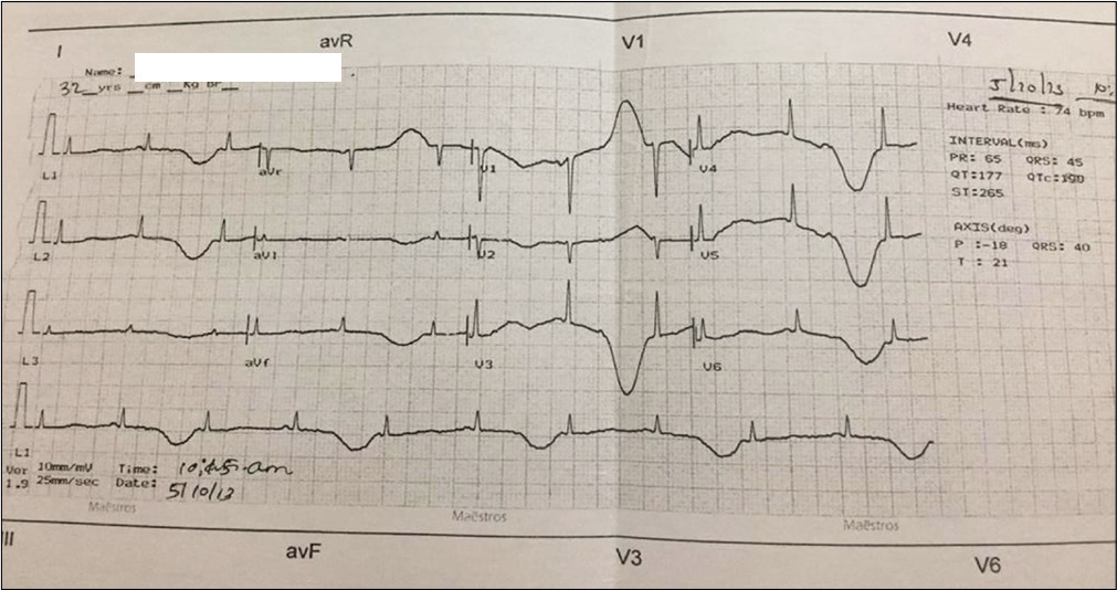 ECG is showing prolonged QTc with T-wave alternans of alternating T-wave polarity.