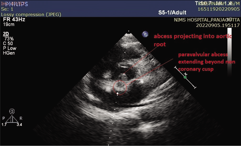 TTE PSAX view showing paravalvular abscess extending beyond non-coronary cusp.