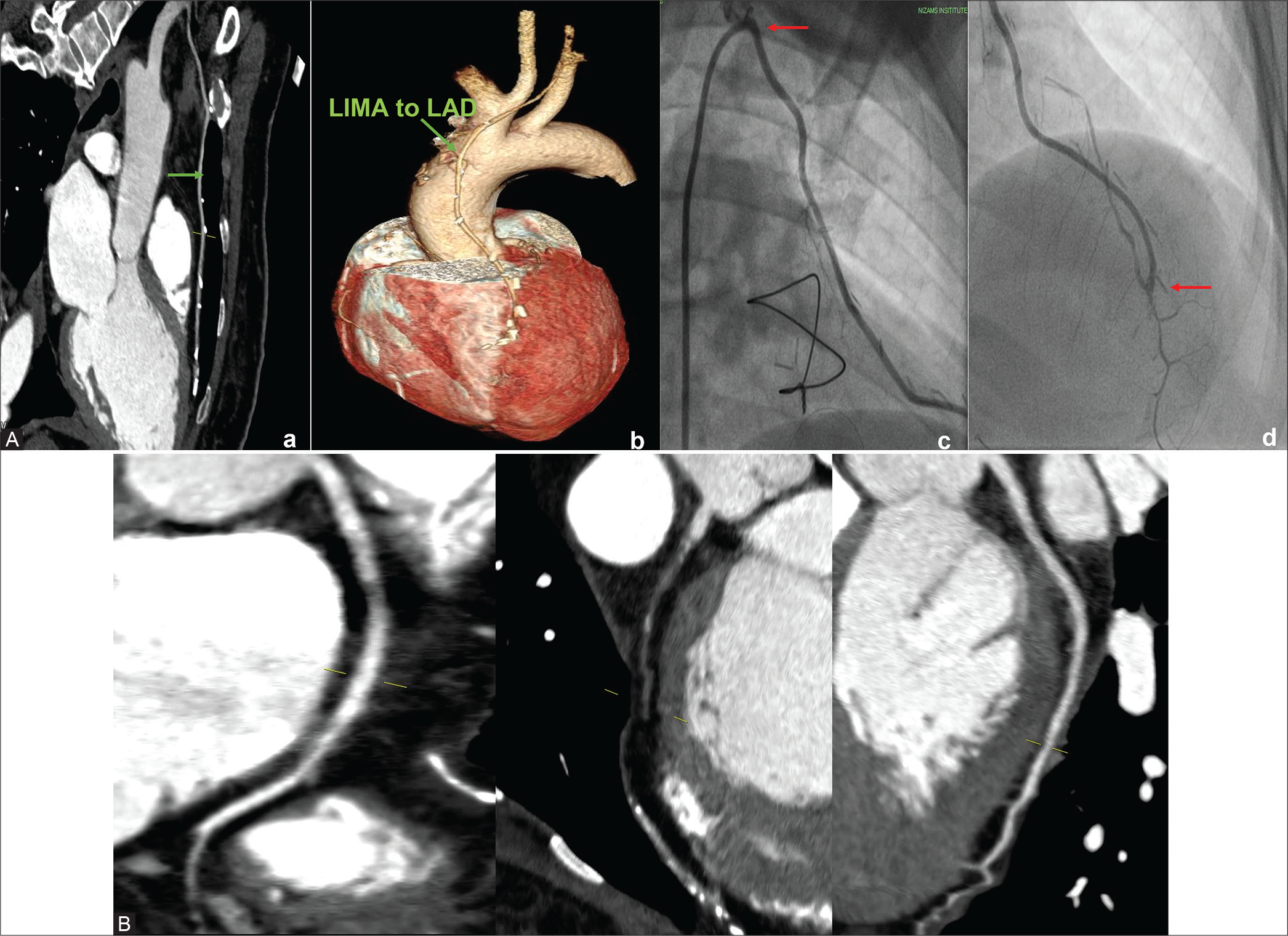 (A) 50/F –CT coronary angiogram (CTCAG) and conventional angiograms reveals- a) Well-opacified LIMA to LAD; b) The same in Volume-rendered reconstruction image; c) Conventional CAG showing LIMA (arrow shows the ostium of LIMA); d) Conventional angiogram showing LIMA (arrow at the anastomotic site). (B) CTCAG showing native RCA with mild disease and diffusely diseased LAD with poor distal run-off.