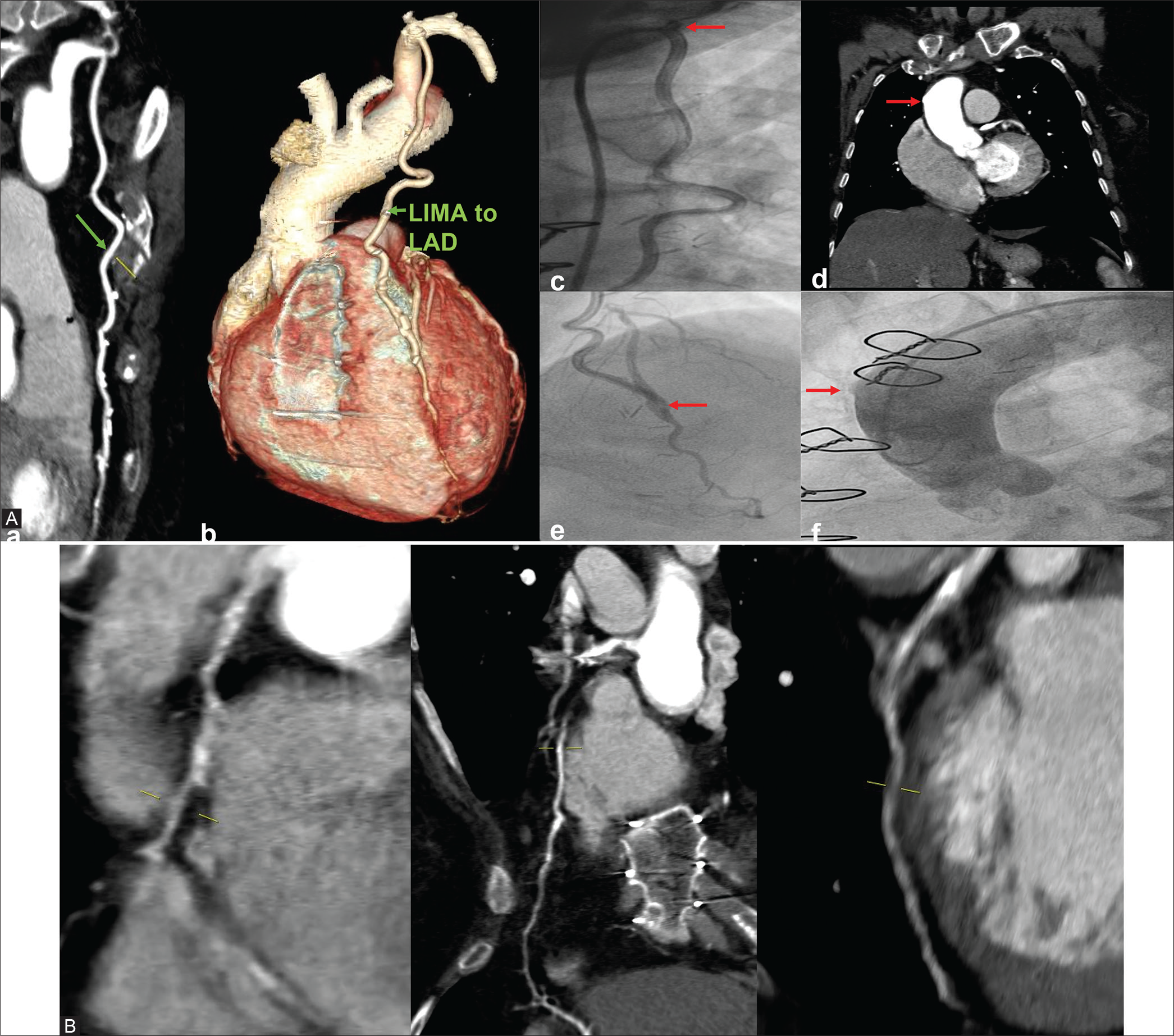 (A) CTCAG and conventional CAG –both show well opacification of LIMA to LAD- a) Patent LIMA to LAD on CTCAG; b) Patent LIMA to LAD on volume rendered reconstruction image; c)Conventional angiogram showing LIMA to LAD ( arrow at the ostio-proximal part); d) Nubbin sign (arrow pointing to nipple like structure) on CTCAG showing proximal total occlusion of graft to RCA; e)Anastomotic site (arrow is pointing) LIMA to LAD on conventional CAG; f) Nubbin sign (nipple like structure pointed by arrow) in conventional CAG indicating proximal total graft occlusion. (B) On CTCAG-Native vessels –RCA,LAD and LCx.