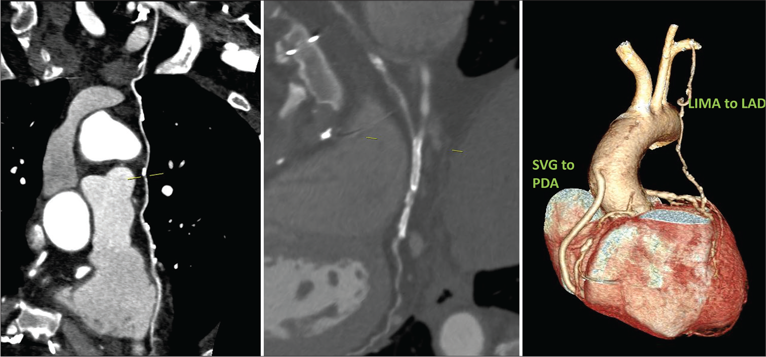 46/F well opacification of bypass grafts with good distal runoff in LIMA to LAD and SVG to PDA as seen in CTCAG (CAG also confirmed the same). Two stents seen in RCA and PLVB with in-stent occlusion in both.