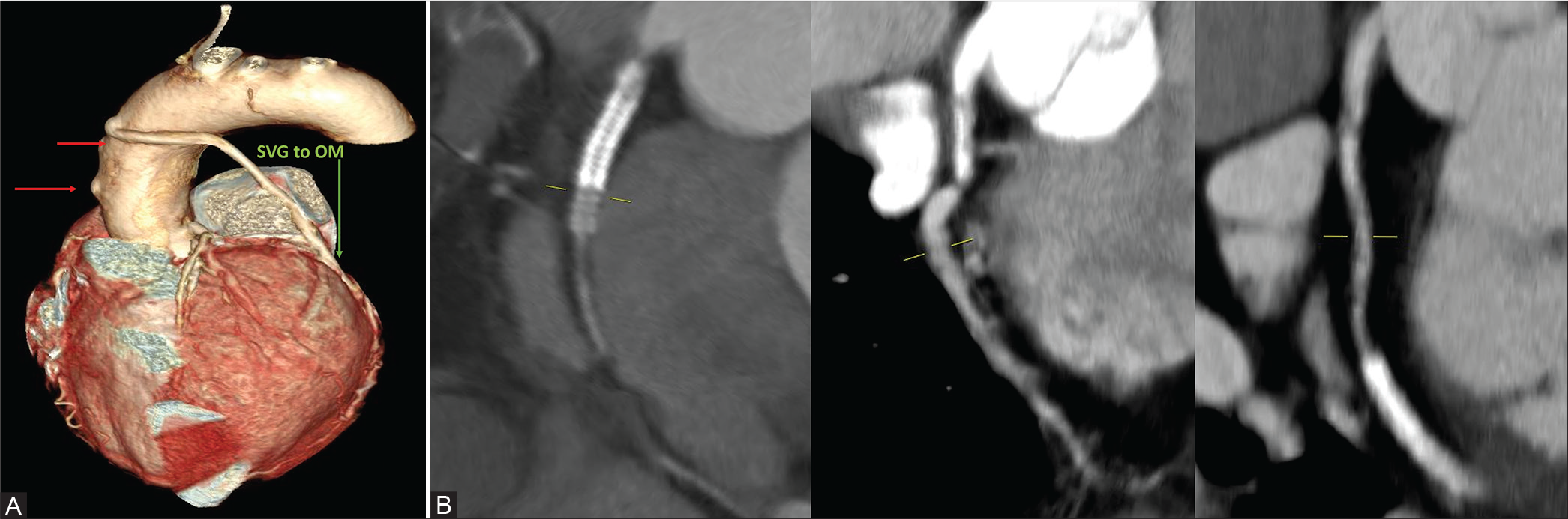 (A) 50/F- Three SVG grafts to OM, LAD, and RCA. SVG to OM graft is patent and the other two are occluded as indicated by arrows in CTCAG. (B) The occluded stent in RCA and patent stent in LCx.