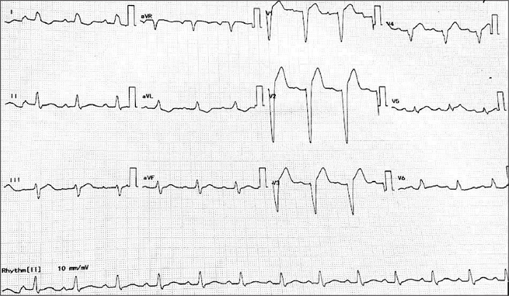 Standardized 12 lead ECG of the proband.