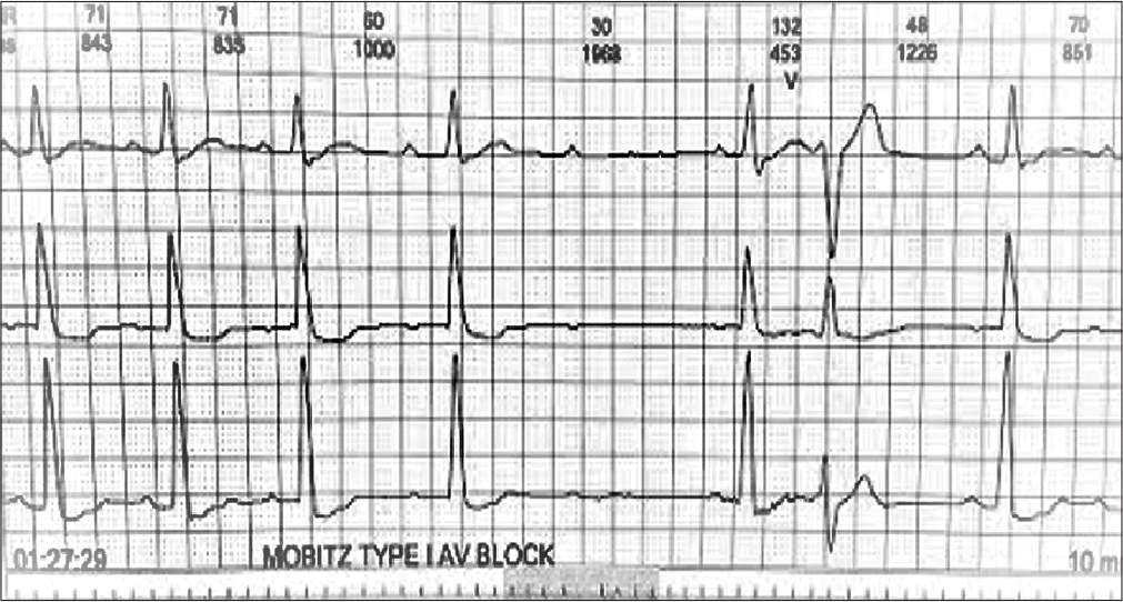 Holter recording showing Mobitz type 1 second degree Atrioventricular Block.