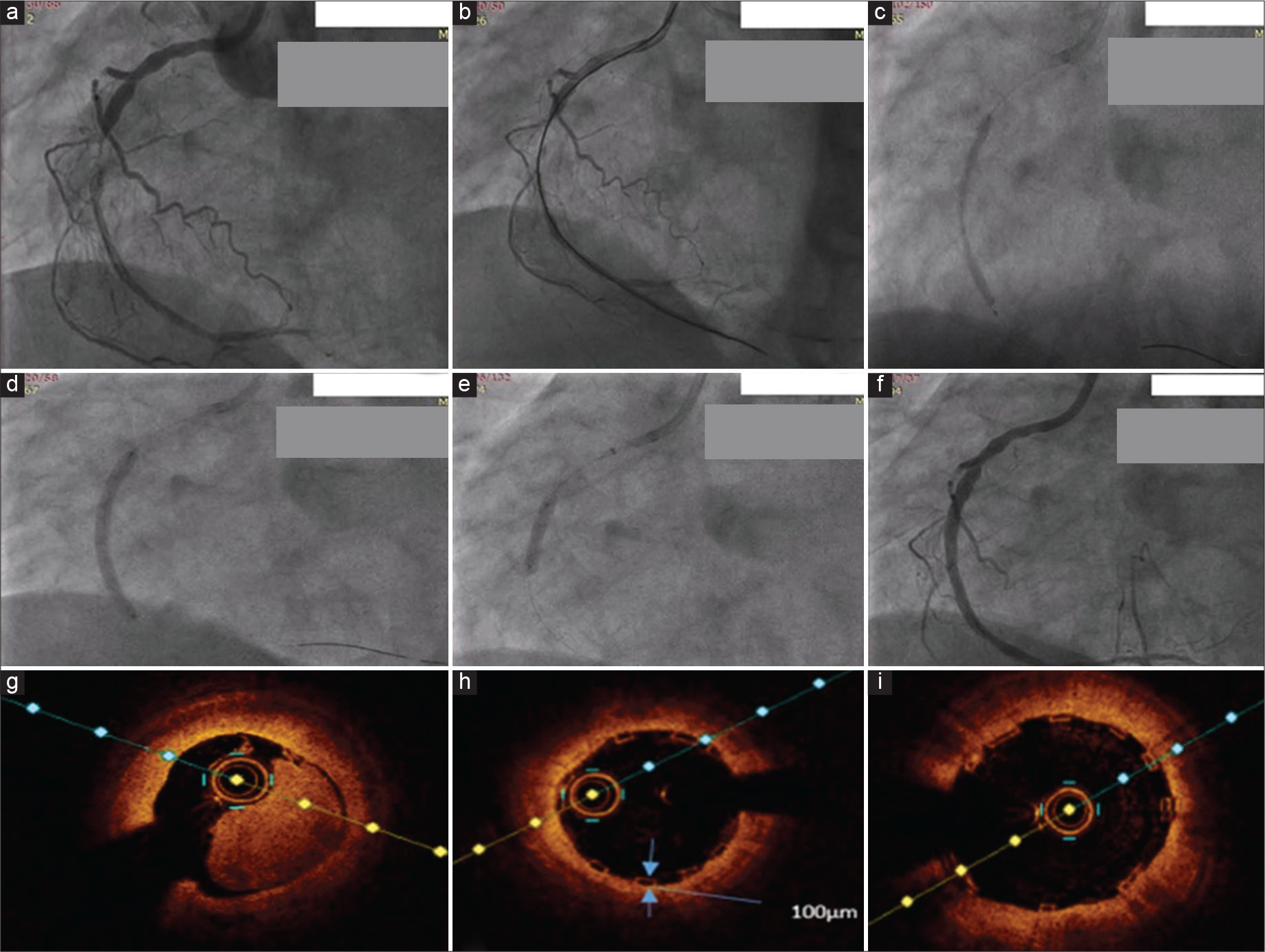 3.25 × 40 mm Meres 100 bioresorbable scaffold (BRS) deployment in a near total occlusion of RCA with image guidance. (a) Near total occlusion of RCA. (b) Lesion crossed with guidewire with guidezilla support. (c) Lesion dilatation done with 2.5 and 3.25 mm balloons. (d) 3.25*40 mm BRS deployed. (e) Post-dilatation with 3.5 mm balloon. (f) Final angiographic picture. (g) Initial OCT run. (h) OCT run after deploying BRS, showing strut thickness of 100 µm. (i) OCT run after post-dilatation showing adequate stent expansion and apposition.