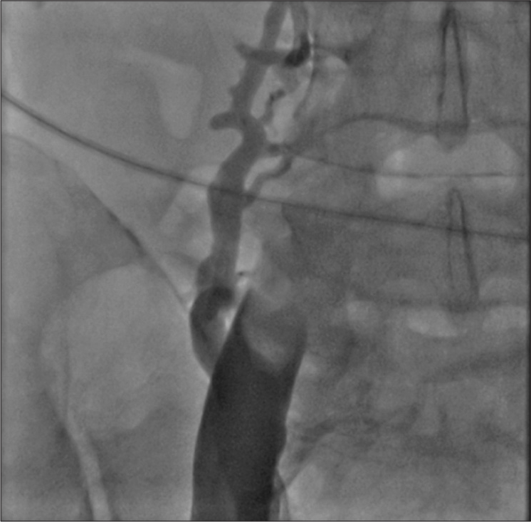 Acute occlusion of inferior vena cava, with thrombus.