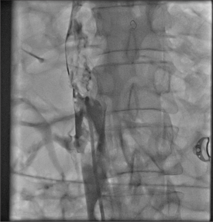 Partial recanalization of inferior vena cava after catheter directed thrombolysis.