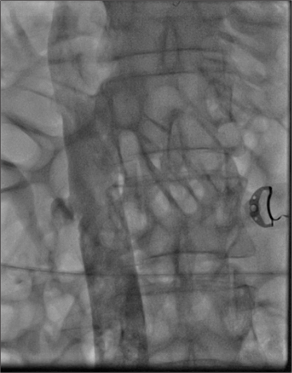 Complete recanalization of inferior vena cava after catheter directed thrombolysis and mechanical thrombus extraction.
