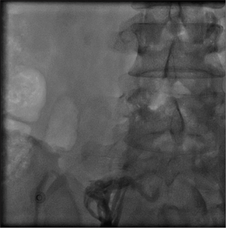 Chronic occlusion of inferior vena cava.