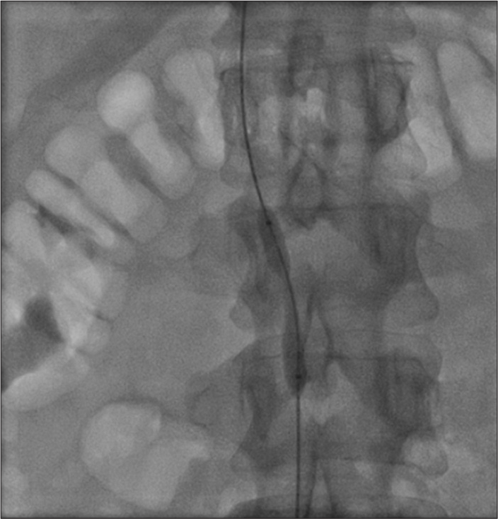 Fibrotic lesion of inferior vena cava, difficult to dilate with 7 mm balloon.