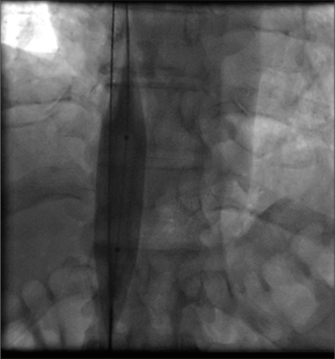 Dilatation of inferior vena cava with 18 mm balloon.