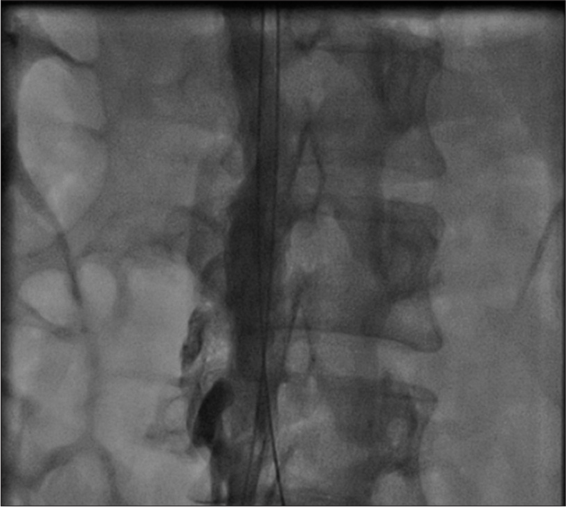 Recanalization of inferior vena cava after balloon dilatation.