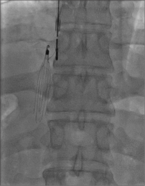 Inferior vena cava filter placement form internal jugular approach.