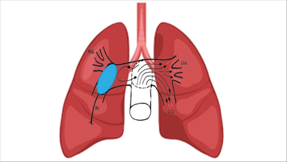 Intrapulmonary local thrombolysis without mechanical breakdown and diversion of thrombolytic agent to opposite pulmonary tree.