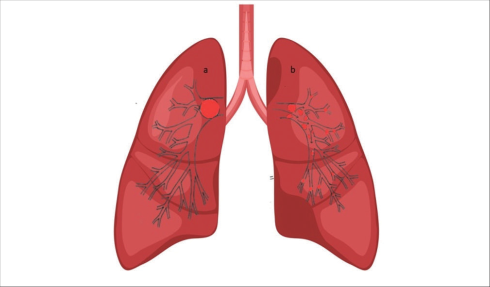 Demonstration of the effect of mechanical breakdown of a completely occluding pulmonary artery embolus pre (a) and post (b) mechanical fragmentation and dispersal of the smaller thrombi in the peripheral pulmonary arterial tree and branches. Fragmentation and distal dispersion decrease paps and improve total pulmonary perfusion.