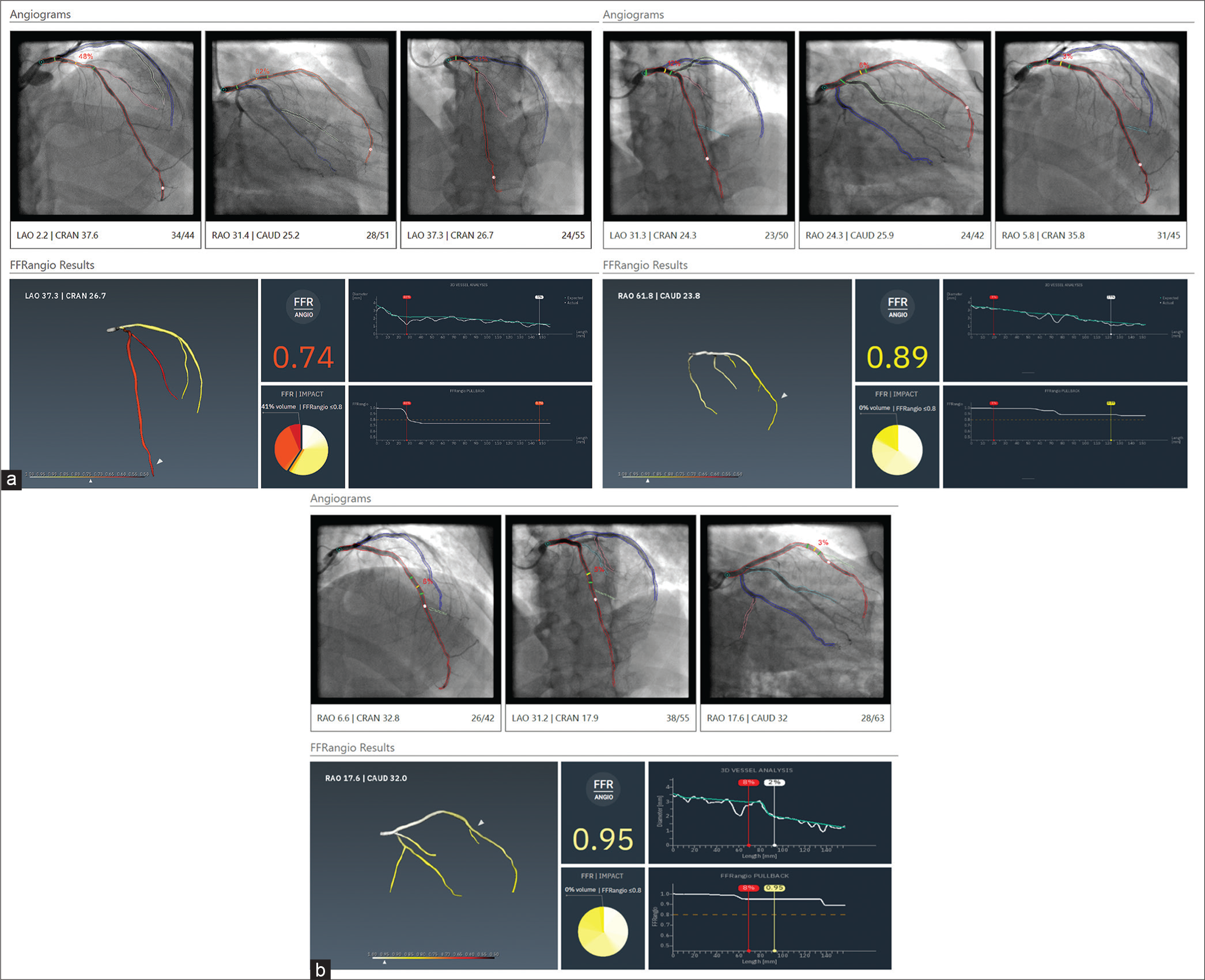 Angiographic reconstruction of the Left anterior descending artery and computation of fractional flow reserve. (a) Pre-percutaneous coronary intervention, (b) post-stent deployment, and (c) post-stent optimization.