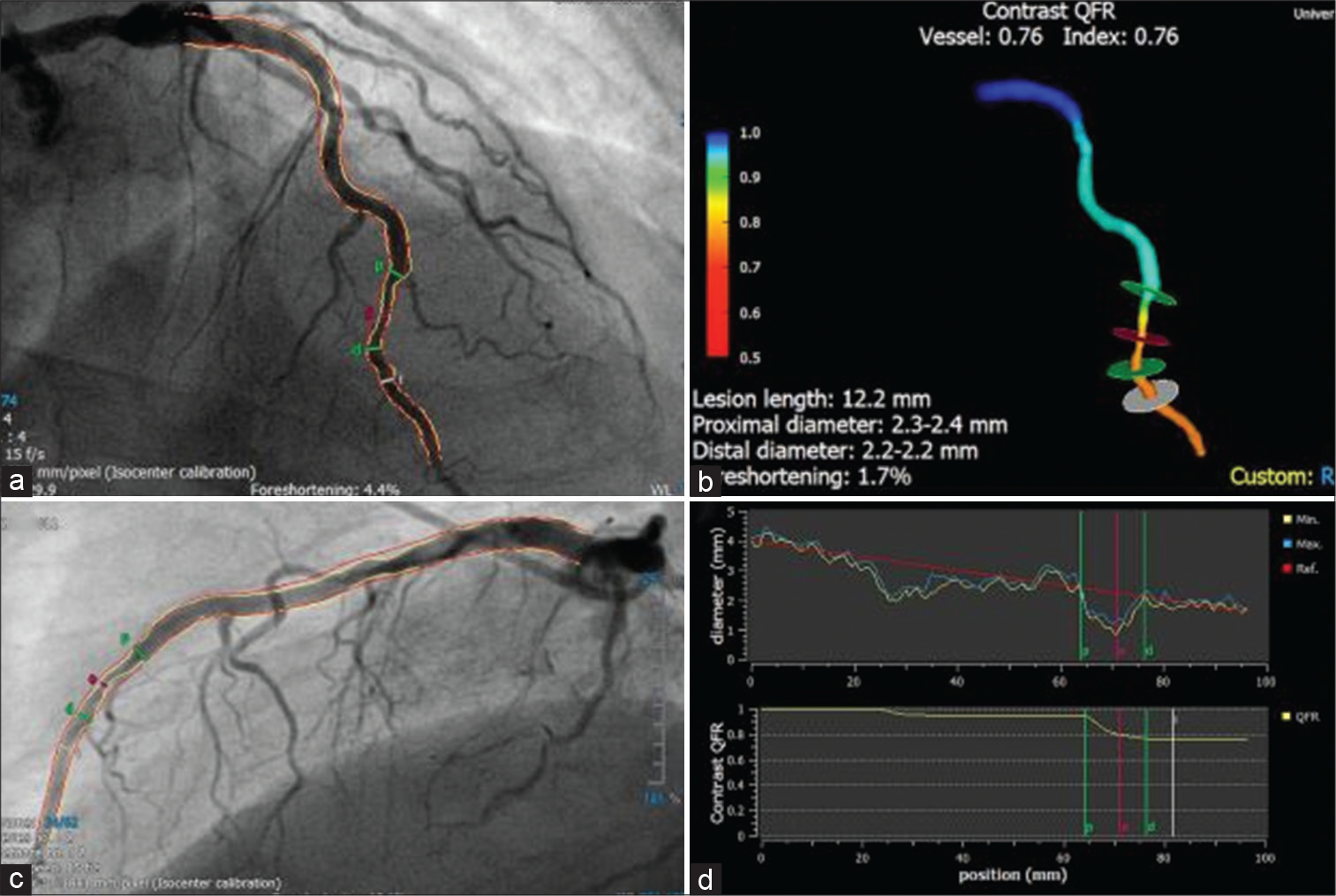 Quantitative flow ratio (QFR) analysis (Courtesy of Xu et al.). An illustration of how angiography might have missed a revascularization signal in the left anterior descending artery, that was significant on QFR with value of 0.76. Here are some pictures showing the vessel’s diameter and QFR curves as measured along its length: (a and b) two angiographic projections separated by a 25° angle; (c) a 3D reconstruction of the vessel; and (d) vessel diameter, and QFR curves over the length of the vessel.