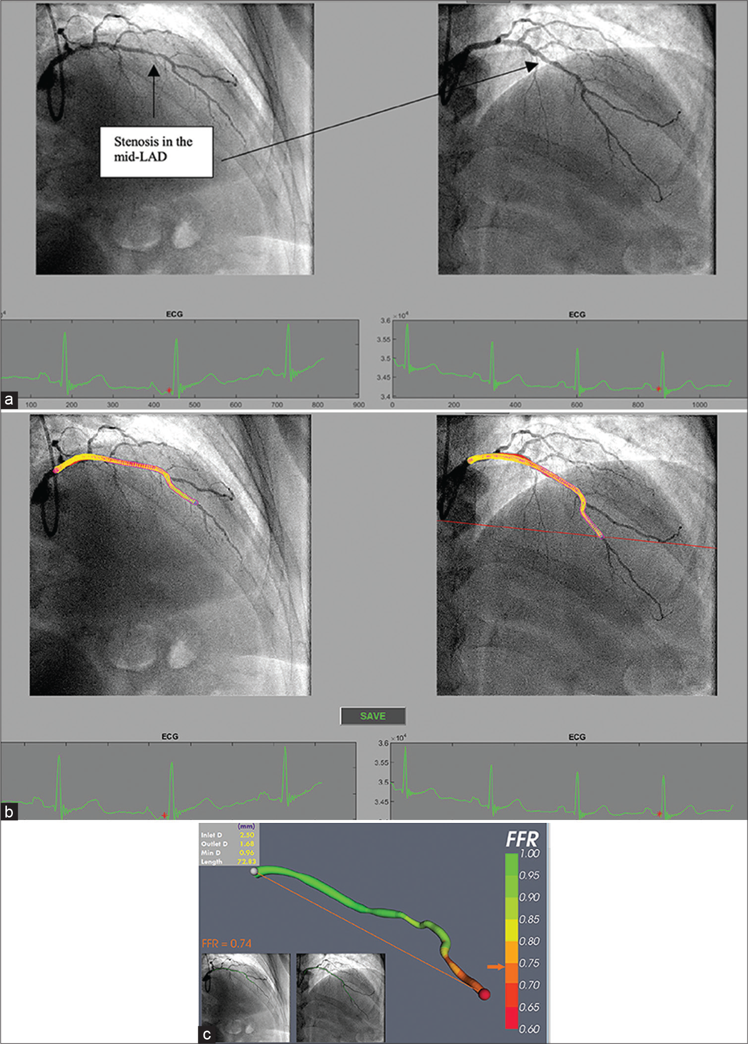 (a) Processing selected angiogram images. Two views (at least 30° apart) of the LAD are chosen at end diastole (red dot on ECG tracing) from a patient with NSTE-ACS. (b) The LAD artery is now segmented and ready for a 3D reconstruction before computational fluid dynamics (CFD) simulation. (c) Virtual (COMPUTED) fractional flow reserve (vFFR) result after 3D reconstruction and CFD simulation showing a vFFR in the LAD of 0.74 (Courtesy of Hazel Arfah Haley et al.).