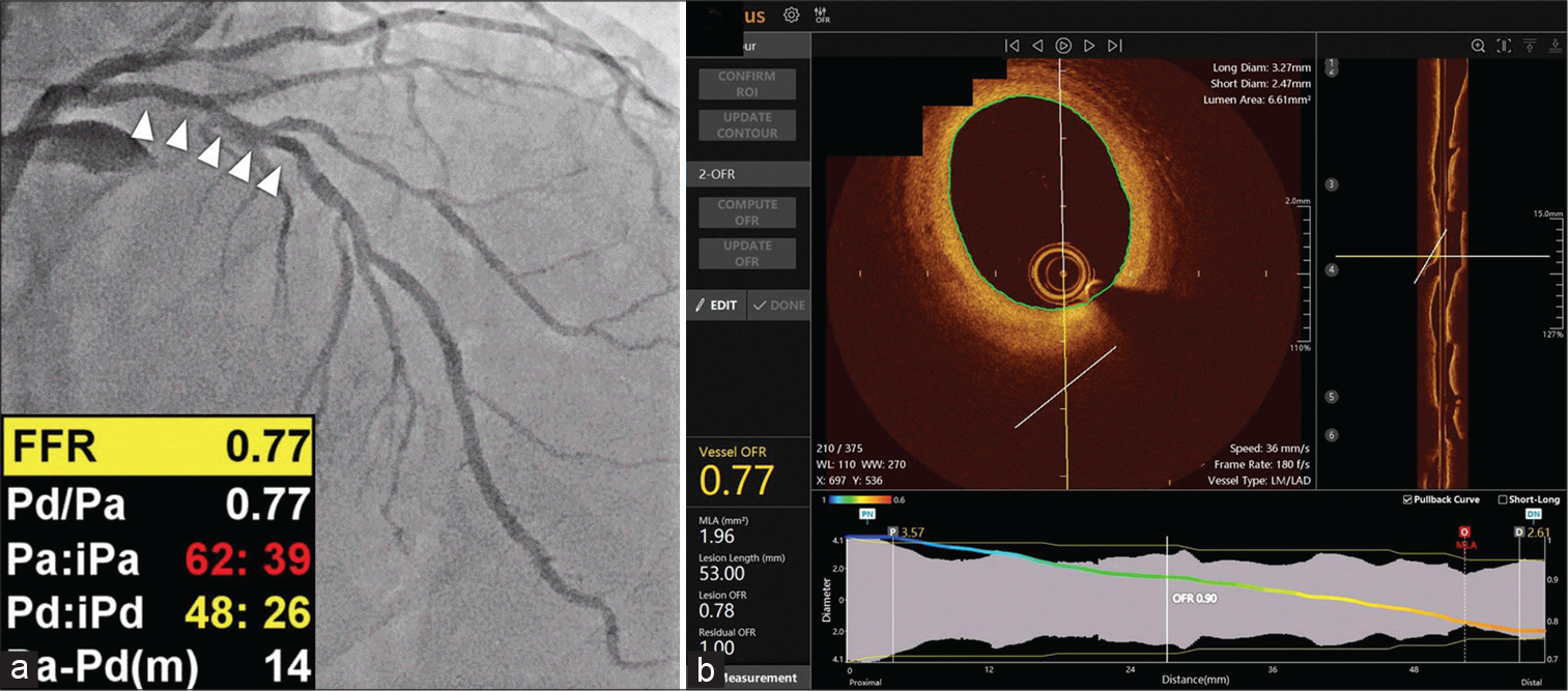 An example of optical coherence tomography (OCT)-derived fractional flow reserve (FFR). (a) Coronary angiography revealed angiographically intermediate stenosis in the proximal part of the left anterior descending artery (arrowheads) with a wire-based FFR value of 0.77. (b) Images obtained from OCT using the FFR value in OctPlus software (Courtsey of Kleanthis Theodoropoulos et al.).