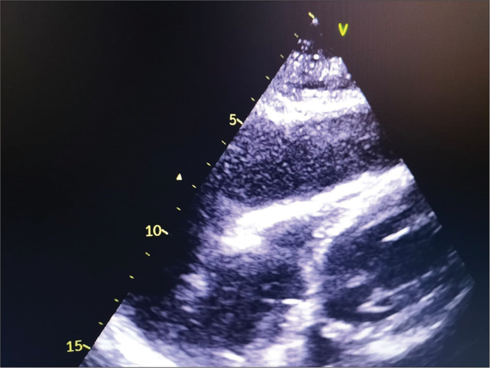 2D ECHO showing pericardial tamponade in a patient with hypothyroidism.