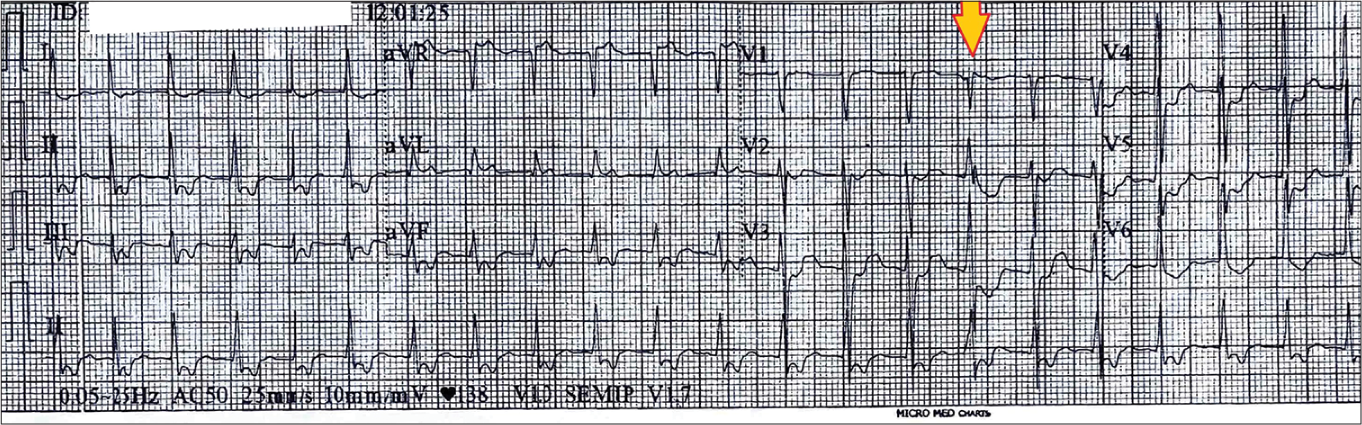 12 lead Electrocardiogram of the patient showing a narrow complex tachycardia with short RP interval. The ventricular premature complex as marked by arrow in leads V1-V3 shows that tachycardia cycle length is unaffected by it giving a clue to the mechanism of tachycardia could be atrioventricular nodal reentry tachycardia.