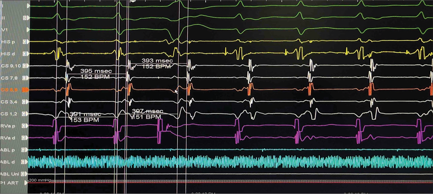 His synchronous premature ventricular contraction (PVC): The His synchronous PVC failed to reset the tachycardia as the tachycardia cycle length in the atrial electrogram is unchanged. Atrioventricular reentry tachycardia is less likely to be the mechanism.
