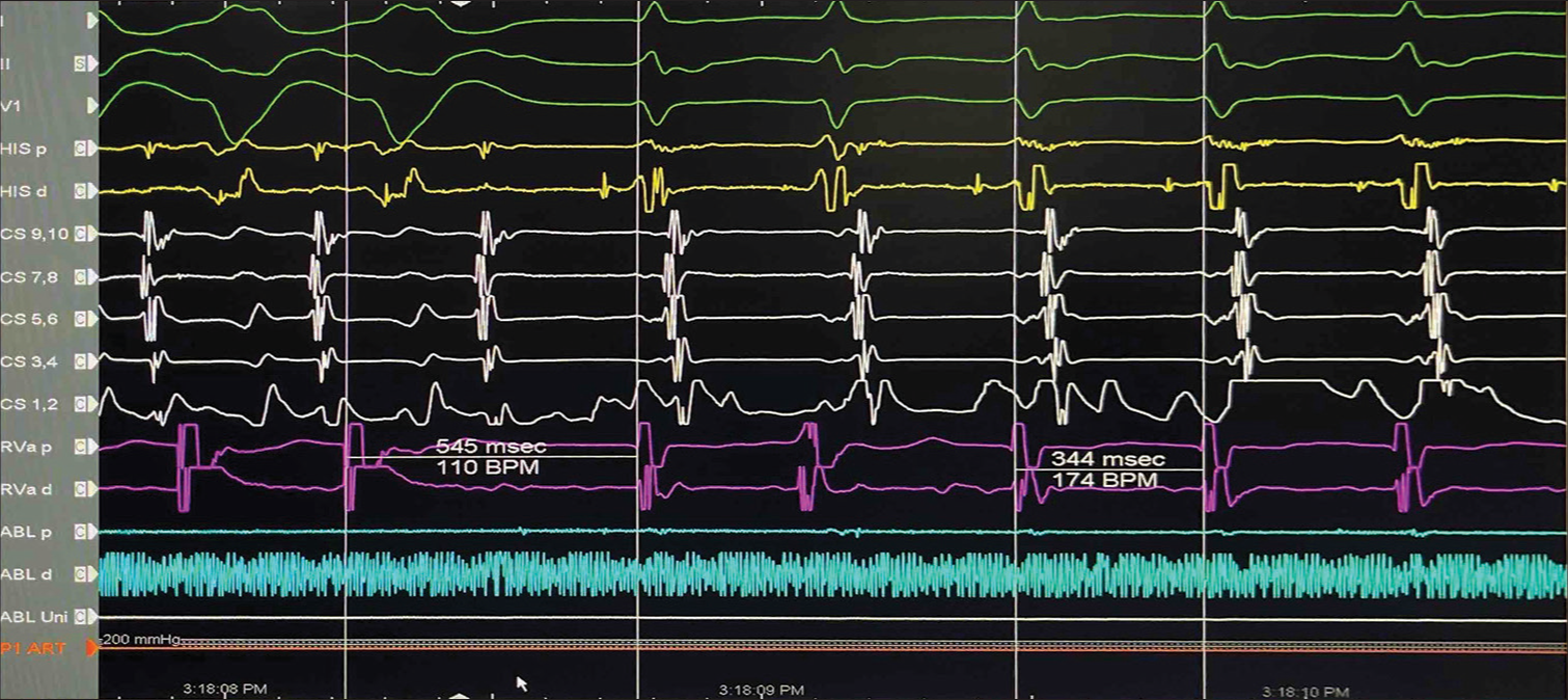 Entrainment during tachycardia: On cessation of ventricular pacing, the post-pacing interval minus tachycardia cycle length was 201 ms which is higher than 115 ms. This goes in favor of atrioventricular nodal reentry tachycardia (AVNRT). Further, the delta ventriculoatrial during V pacing and during tachycardia are more than 85 msec, favoring the mechanism to be AVNRT. Repetitive Entrainment episodes via V pacing during the Tachycardia documented VA linking, thus make sAT unlikely.