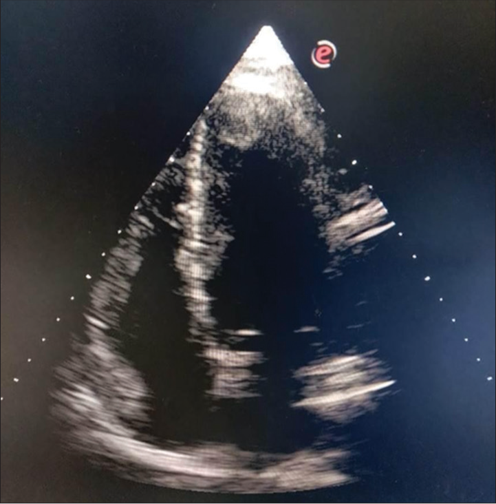 This picture shows two-dimensional echocardiography (apical four-chamber view) with the left ventricular thrombus attached to the apex.