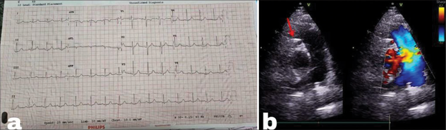 (a) Electrocardiography with no significant ST-T changes. (b) Parasternal short-axis echocardiogram view depicts a small anomalous channel (red arrow) representing the left coronary artery draining from the pulmonary artery.