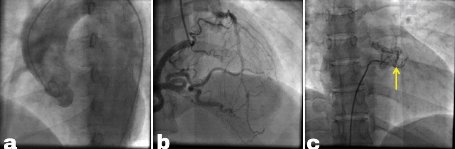 (a) Pigtail aortogram displays an empty left sinus with no coronary arteries originating from it. (b) Angiogram of the right coronary artery (RCA) reveals a significantly enlarged RCA with retrograde filling of the left coronary artery, draining into the pulmonary artery (PA). (c) PA angiogram showing partial filling of the left coronary artery (yellow arrow) due to competitive flow.