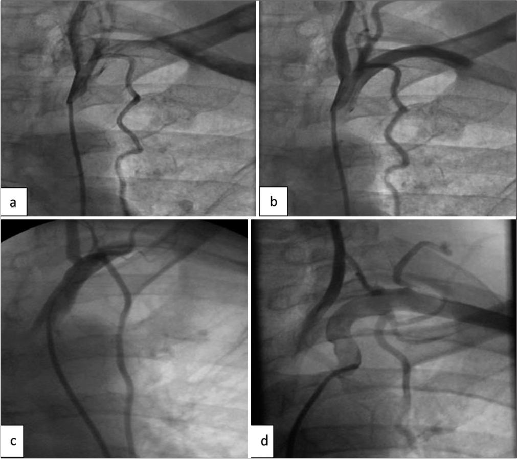 Common origin of the LIMA. (a and b) LIMA arising as a common origin with Thyrocervical trunk. (c) common origin of LIMA with costocervical trunk. (d) Common origin of LIMA with dorsal scapular artery. (LIMA: Left internal mammary artery.)