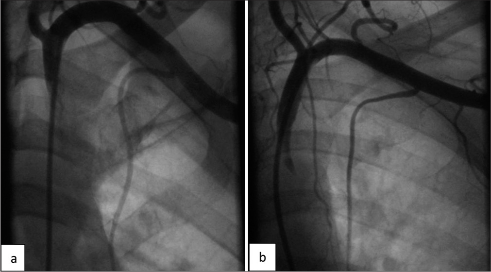 Ectopic origin of the LIMA. (a and b) Ectopic origin of the LIMA arising from the 3rd part of subclavian artery. (b) Acute angulation of LIMA. (LIMA: Left internal mammary artery.)