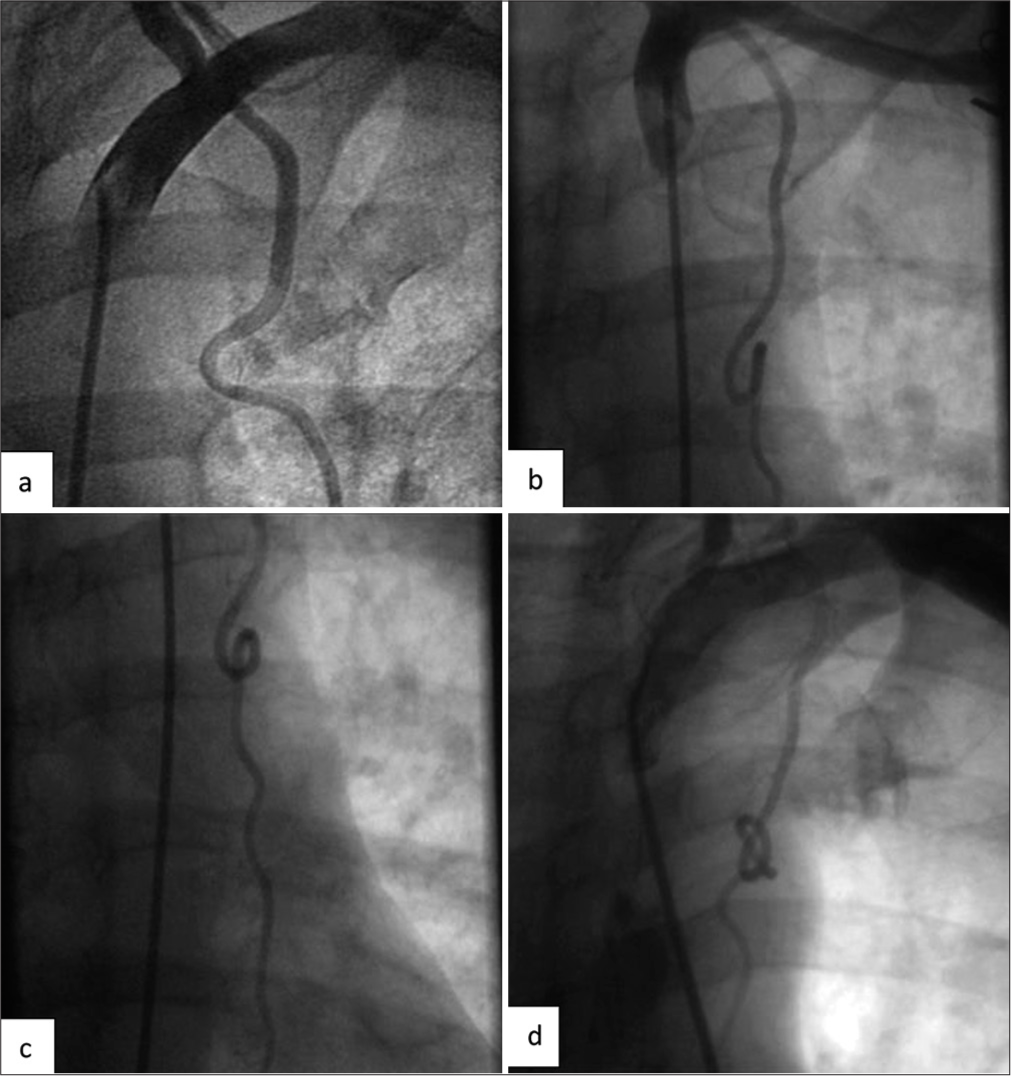 Tortuous course of LIMA. (a-d) Tortuous course of LIMA with kink, loop, and coils. (a) Kinking. (b) Looping of LIMA. (c and d) Coiling of the LIMA. (LIMA: Left internal mammary artery.)