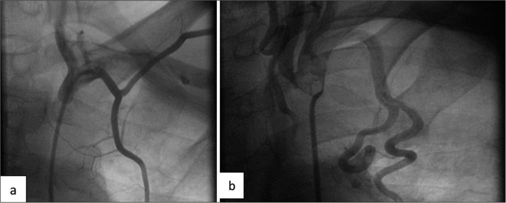 Large side branch of LIMA. (a and b) Large costal branches arising from the lateral aspect of LIMA. (LIMA: Left internal mammary artery.)