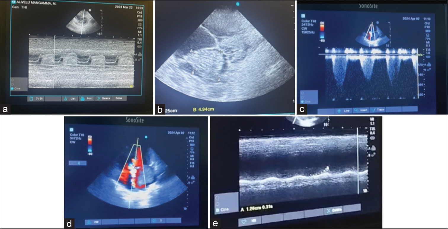 (a) M mode of two-dimensional echocardiogram, (b) two-dimensional echocardiogram showing left atrium myxoma, (c) four-chamber view showing tricuspid regurgitant jet, (d) color Doppler of apical four-chamber view showing tricuspid regurgitation, and (e) tricuspid annular plane systolic excursion of the patient showing right ventricular dysfunction.