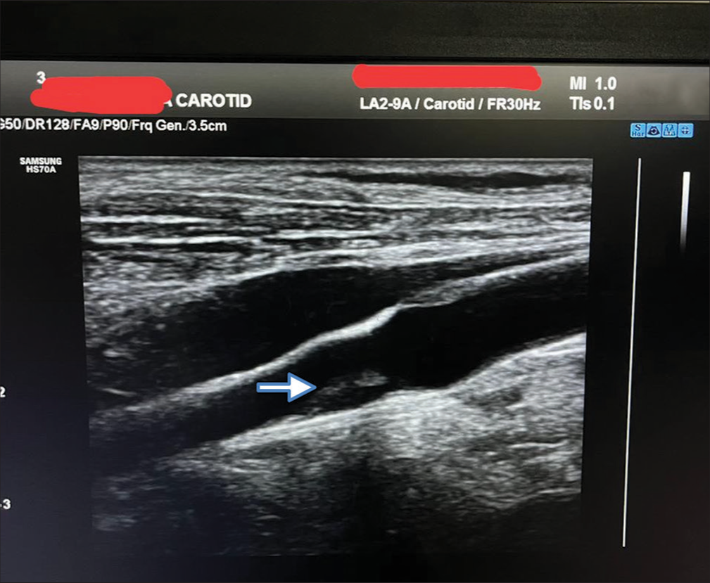 Ultrasonographic image of carotid artery showing an isoechoi c plaque. Bluish white arrow shows an isoechoic plaque.