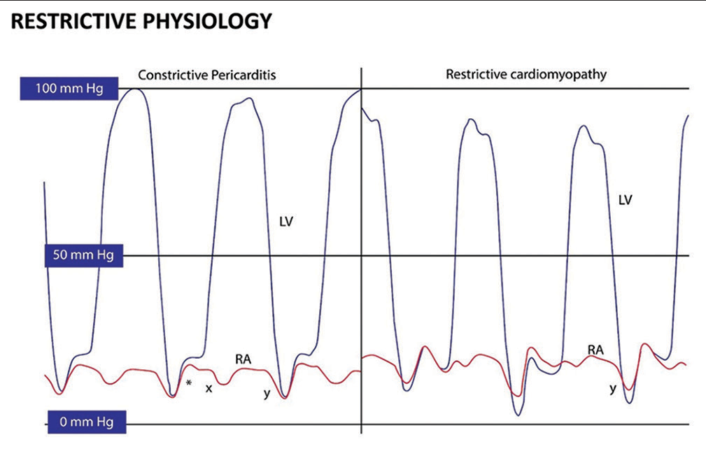 (Left) left ventricular (LV)-dark and right atrium (RA)-red hemodynamics in constrictive pericarditis. “x” and “y” descents are prominent with a square root sign (*). (Right) LV-dark and RA-red hemodynamics in restrictive cardiomyopathy. A prominent “y” descent is present, but the “x” descent is blunted.