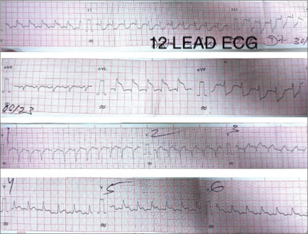 12 Lead ECG showing extensive ST-segment elevation myocardial infarction. (ECG: Electrocardiogram).