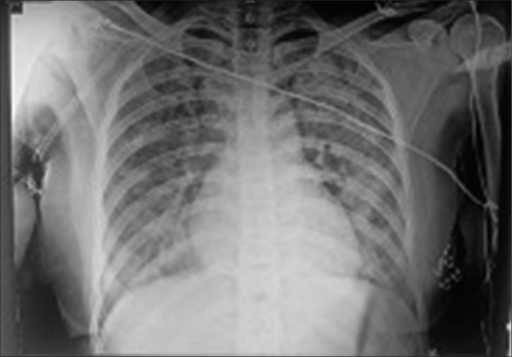 Chest X-ray anterior-posterior view.