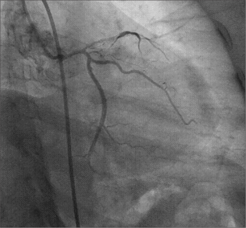 Diffuse ulcerative lesion containing thrombus from ostioproximal to mid left anterior descending artery.
