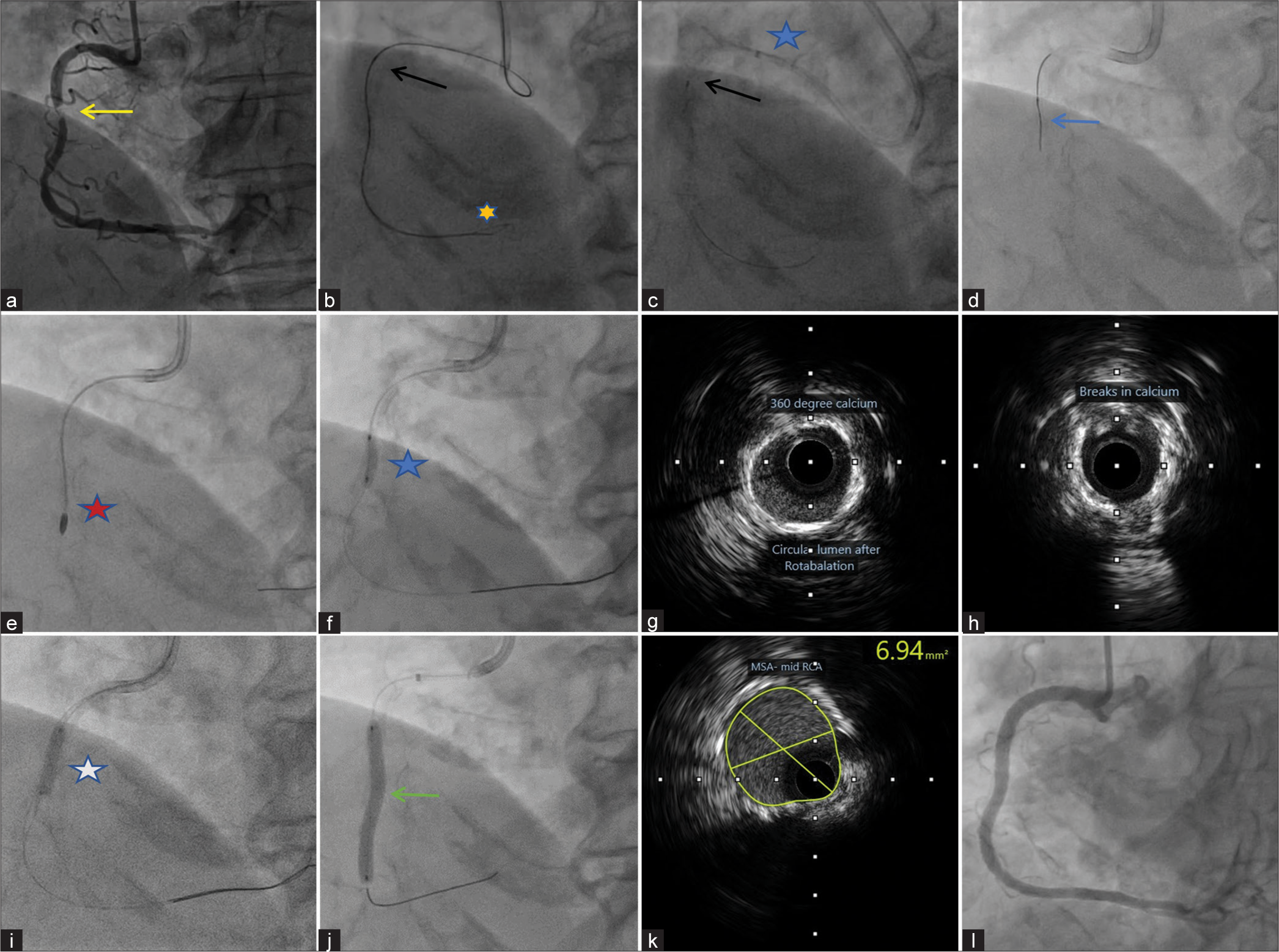 (a) Coronary angiography left anterior oblique projection (LAO) 30, showing tight lesion in proximal right coronary artery (RCA) (yellow arrow), (b) Fluoroscopic image showing difficulty in crossing the lesion using low profile balloon (black arrow), even with a buddy wire (yellow star), (c) Fluoroscopic image showing difficulty in crossing the lesion using low profile balloon (black arrow) even with guideliner support (blue star), (d) lesion crossed directly using rota floppy wire (blue arrow), (e) rotablation with 1.5 mm red star- rota burr, (f) pre-dilation with 2.75 × 9 mm blue star- dog boning effect while balloon inflation, (g and h) intravascular ultrasound (IVUS) image showing nearly 360° calcium and some breaks after rotablation (i) 3 × 12 mm white star- lithotripsy balloon, (j) stenting with 3 × 28 mm and 3.5 × 23 mm drug eluting stent, with uniform stent expansion (green arrow), (k) post-stent IVUS image yellow circled area- is minimal Stent area (MSA) of 6.94 mm 2, and (l) final angiogram with good end result.