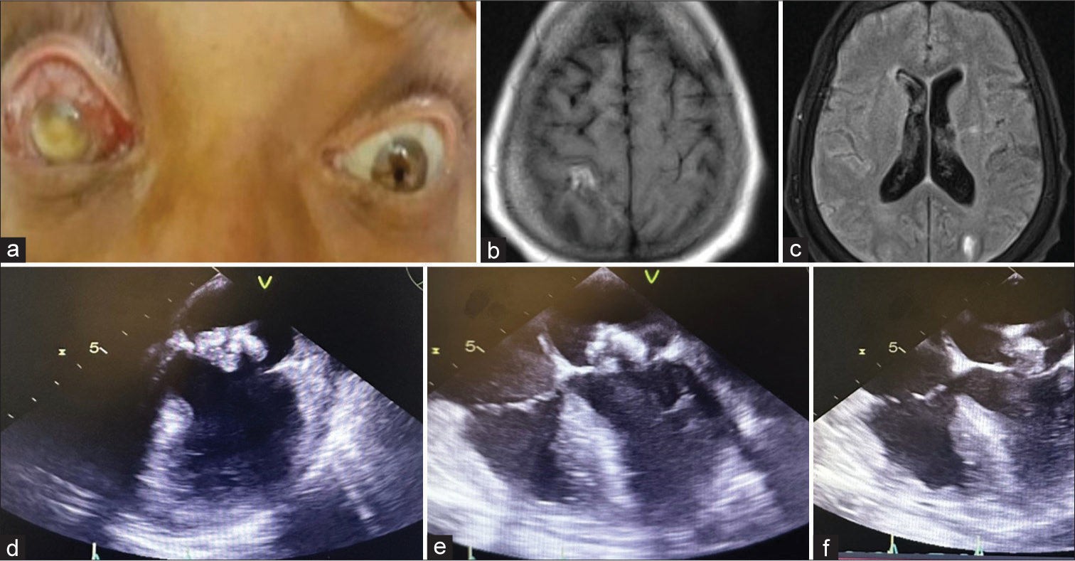 (a) Right eye clinical photograph showing endophthalmitis, (b and c) Magnetic resonance imaging of the brain showing hyperintense areas in the right frontoparietal and left occipital regions in the fluid attenuated inversion recovery images. (d-f) Transesophageal echocardiogram showing vegetation over the mitral leaflet.