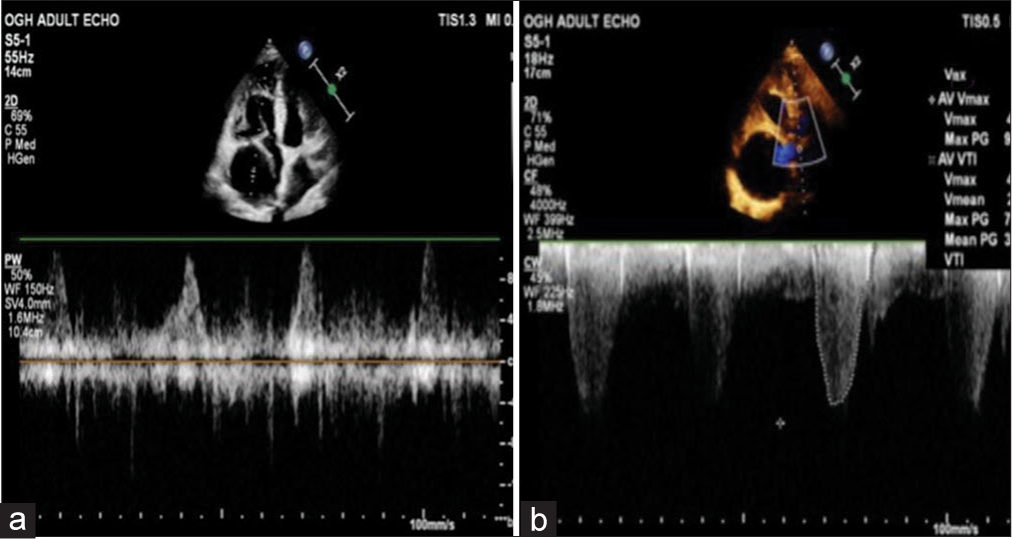 (a) Pulse wave Doppler within the hypoechoic mass showing pulsatile flow pattern and (b) continuous wave Doppler (CWD) at the level of the aortic valve showing severe aortic stenosis.