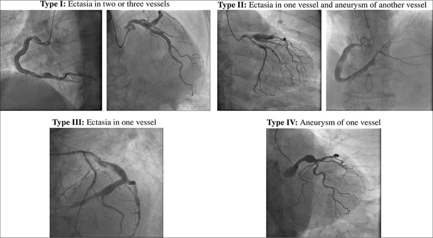 Markis classification of coronary artery aneurysm.