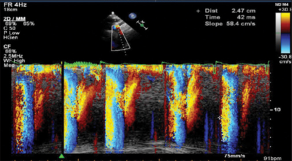 Echocardiographic determination of aortic propagation velocity.