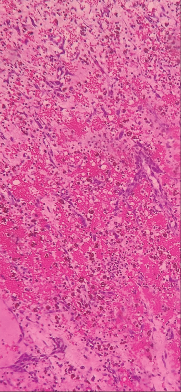 Hematoxylin and eosin staining of biopsy of the left atrium myxoma.