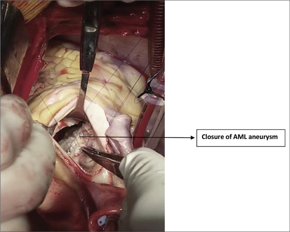 Closure of anterior mitral leaflet (AML) aneurysm.