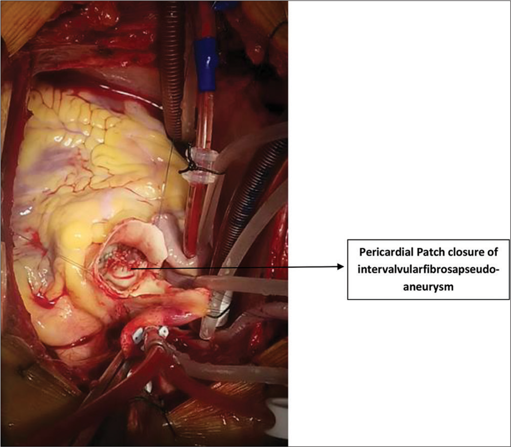 Pericardial patch closure of intervalvular fibrosa pseudoaneurysm.